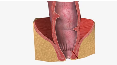 Cara Merawat Fistula Ani