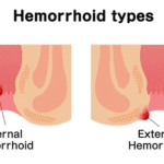 Wasir Eksternal dan Internal