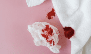 Wasir Sering Berdarah