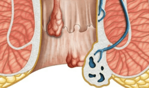 Penyebab Abses di Anus