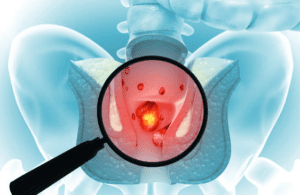 Ambeien Benjolan Banyak