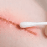 Membersihkan Luka Ambeien