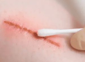 Luka Pantat Tak Kunjung Sembuh