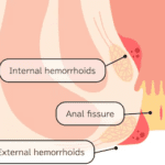 Apa Perbedaan Ambeien dan Fisura Ani?
