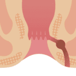 Tanda Fistula Ani yang Harus Segera Diobati