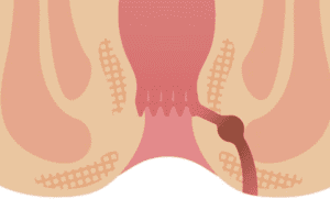 Fistula Susah Sembuh Total