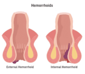 Ambeien Internal Aktif
