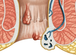 Fistula Ani Abses