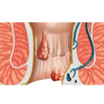 Operasi Fistula Ani di Mana