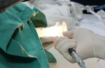 Operasi Wasir Metode Laser
