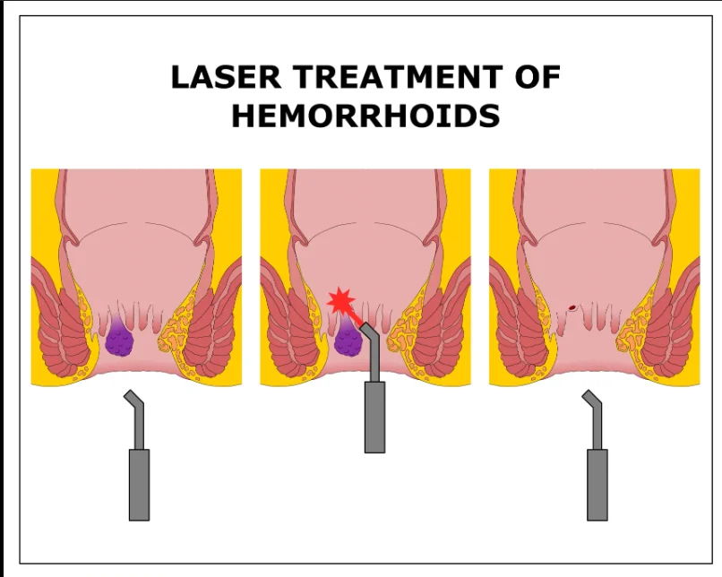 Operasi Wasir Metode Laser di ST Wasir Center