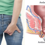 Cara Berobat Ambeien