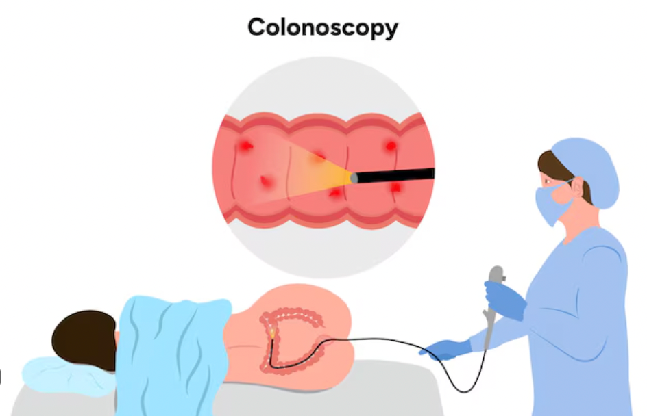 Kolonoskopi Berguna untuk Apa?