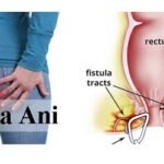 Fistula Ani Bisa Sembuh Total Tidak?