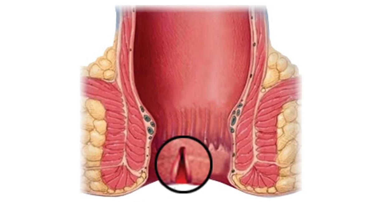 Tindakan Operasi Fisura Ani
