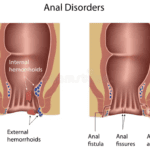Fisura Ani atau Fistula Ani