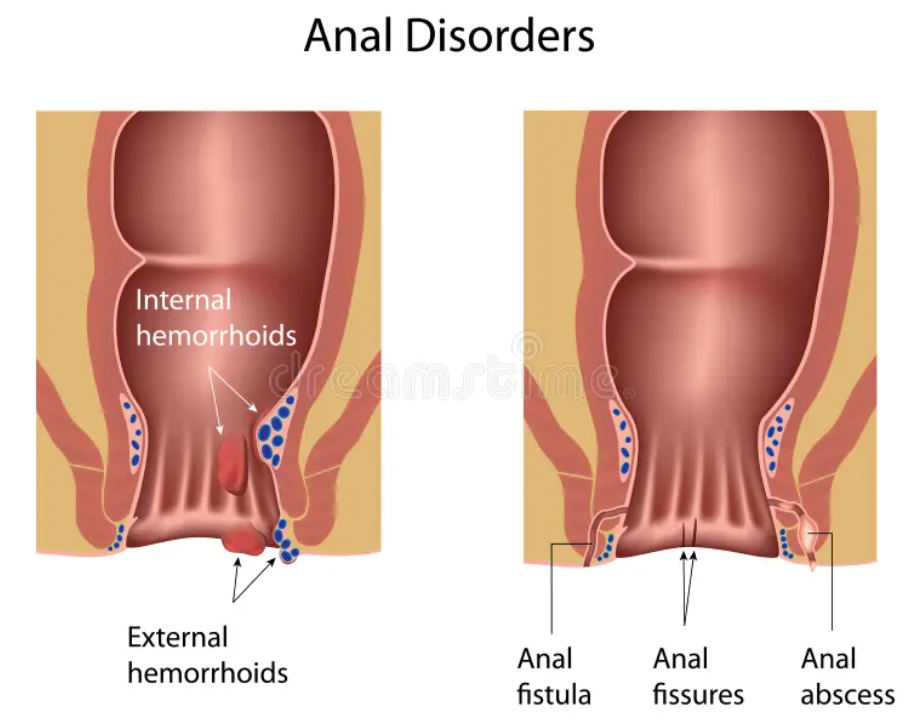Fisura Ani atau Fistula Ani: Apa Perbedaannya?