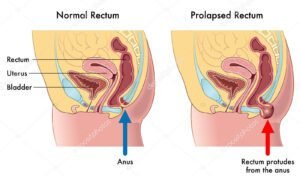 Bentuk Anus yang Sehat