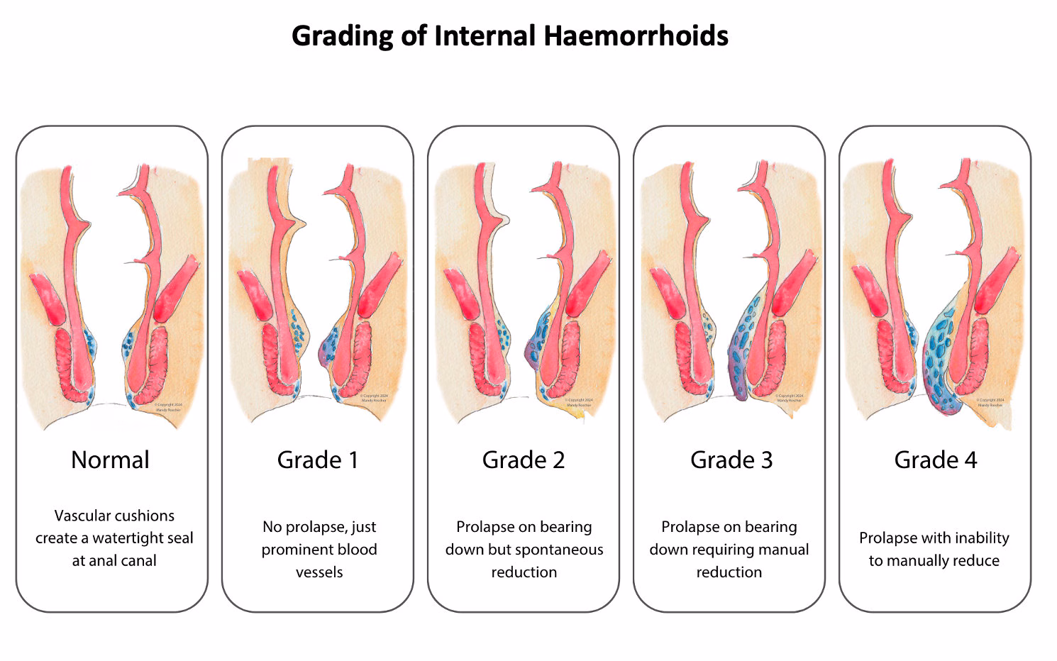 Wasir atau Ambeien Grade 1–4