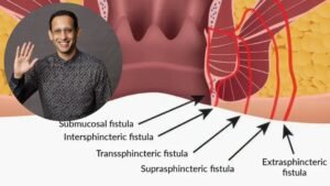 Nadiem makarim fistula ani